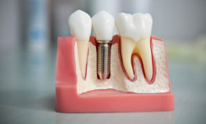 цены на протезирование зубов