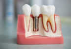 цены на протезирование зубов